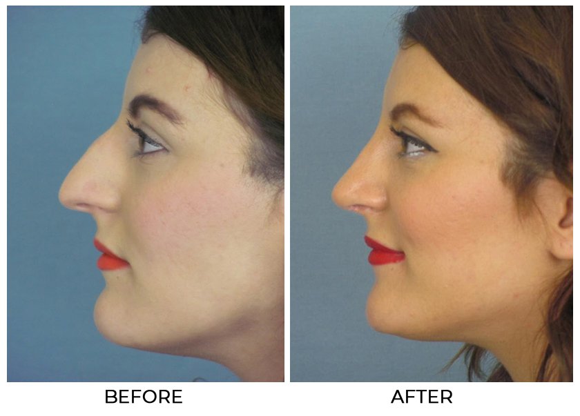 Before and After Treatment Photos - Cosmetic Rhinoplasty - left side view, female patient 1
