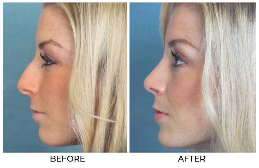 Before and After Treatment Photos - Cosmetic Rhinoplasty - left side view, female patient 2
