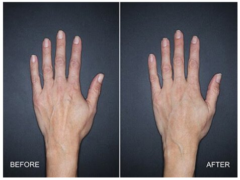 Restylane Lyft for the hands - Before and After Treatment Photos - female patient 1, hands