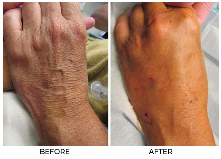 Restylane Lyft for the hands - Before and After Treatment Photos - female patient 2, hands