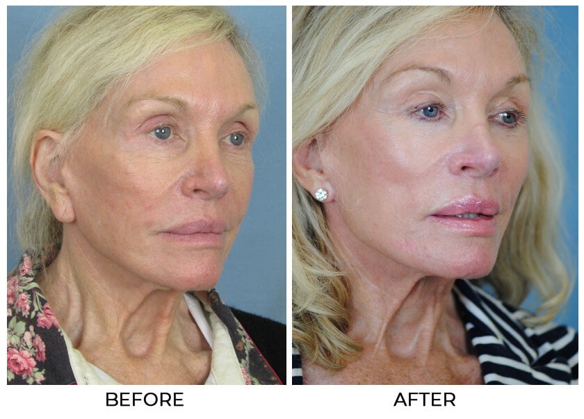 Before and After Treatment photo - CHARLESTON FACIAL PLASTIC SURGERY - female patient, oblique view