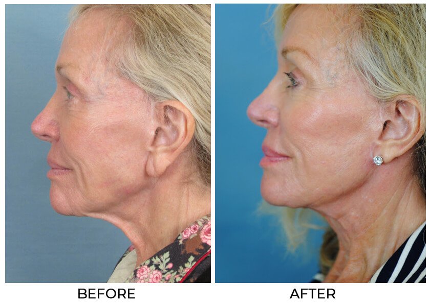 Before and After Treatment photo - CHARLESTON FACIAL PLASTIC SURGERY - female patient, left side view