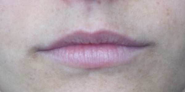 Silicone Lips Before and After 01 | Thomas Funcik MD