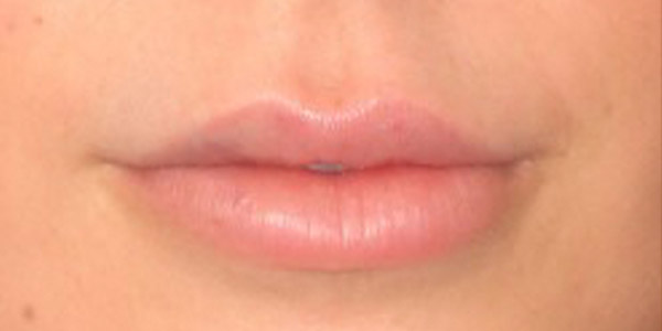 Silicone Lips Before and After | Thomas Funcik MD