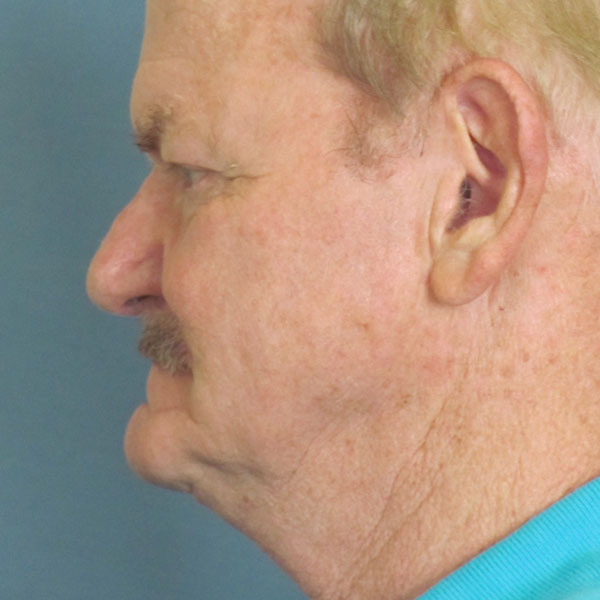 W Plasty Neck Lift Before and After | Thomas Funcik MD