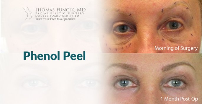 Phenol Peel - Thomas Funcik MD  Blog